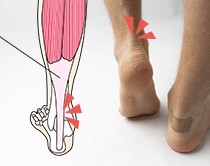 キレス腱炎でのしこりの原因