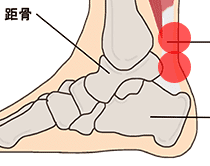 アキレス腱炎の検査法