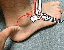 腓骨筋腱炎でくるぶしが痛む原因