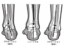 プロネーション障害がくるぶしの痛み