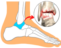足首の痛みは関節に起こる