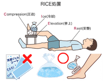 捻挫の応急処置RICEとは？