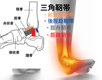 足関節捻挫（外返し捻挫）