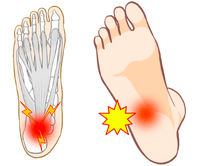 足底腱膜炎（足底筋膜炎）