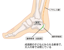 セーバー病（踵骨骨端症）