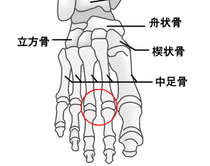 フライバーグ病（第3中足骨の無腐性骨壊死）