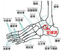 足根洞症候群