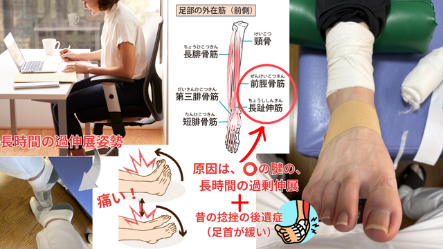 デスクワーク後に突然、足首が激痛で歩けない！？過去の捻挫が引き起こす「前脛骨筋腱」のトラブルと解消法