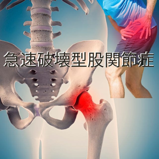 急速破壊型股関節症の原因と対処法|股関節の痛みを救うさいたま中央フットケア整体院