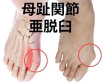 外反母趾テーピングは母趾の関節脱臼の予防と改善に効果的|さいたま中央フットケア整体院
