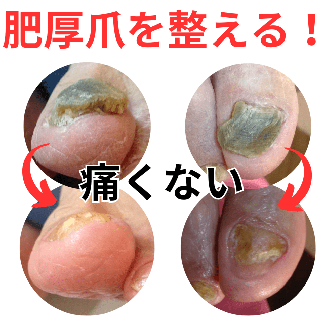 肥厚爪|高齢者の爪が肥厚した場合の切り方|さいたま中央フットケア整体院