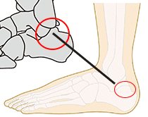 踵の奥が痛い、距骨下関節