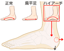 ハグルンド病の原因（踵の下方変位）