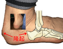 ハグルンド病の原因（先天的に踵の骨が隆起）