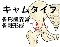 股関節インピンジメント症候群（FAI）のPincer type（ピンサータイプ）