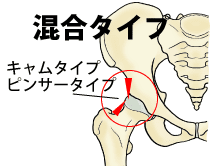 股関節インピンジメント症候群（FAI）のMixed type