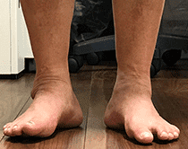 足関節の拘縮
