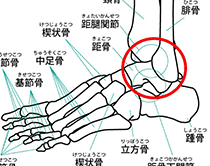 特発性距骨壊死