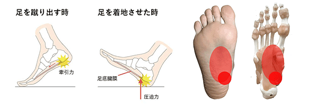 足底腱膜炎の発症メカニズム