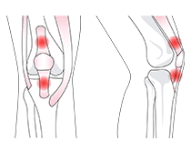 ジャンパー膝、膝蓋腱炎、大腿四頭筋腱付着部炎とは