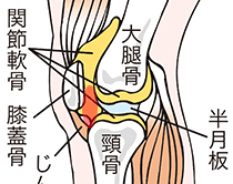 膝蓋下脂肪体炎