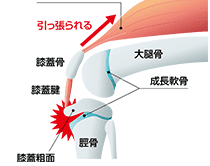 オスグット・シュラッター病とは
