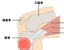 駕足炎