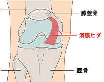 タナ障害（膝滑膜ひだ障害）