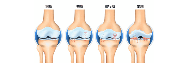 変形性膝関節症