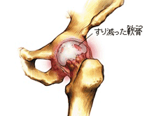股関節の急な痛みの原因