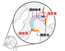 股関節の急な痛みの原因