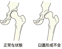 臼蓋形成不全