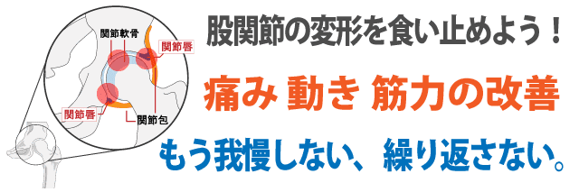 変形性股関節症の原因