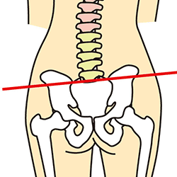 骨盤の歪み