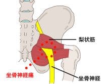 梨状筋症候群とは|さいたま中央フットケア整体院