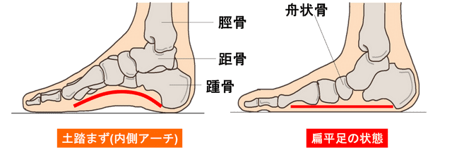 足底腱膜炎の原因に!