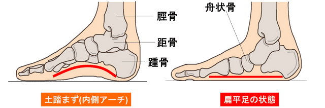 足底腱膜炎の原因に！