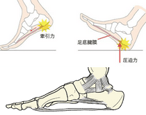 ウィンドラス機構