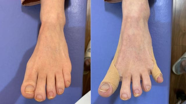 母趾と小指のテーピング法は、モートン病の圧迫を緩和させる目的があります。