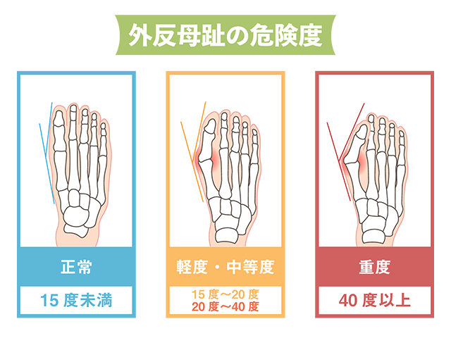 外反母趾のガイドラインは角度（HV角）で分類される|さいたま中央フットケア整体院