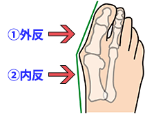 外反母趾