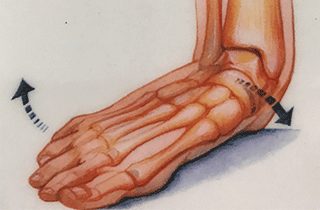 中足骨骨頭痛の足裏アーチ低下、偏平足
