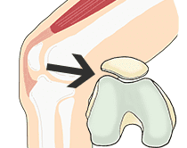 膝蓋大腿関節症の原因