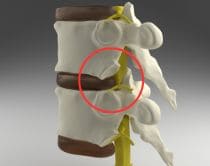 坐骨神経痛の原因が腰部脊柱管狭窄症の場合|さいたま中央フットケア整体院