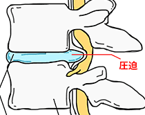 腰部椎間板ヘルニアとは？