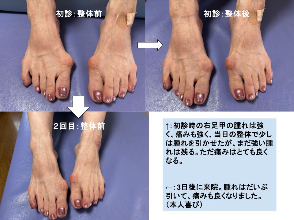 【足の甲の痛み・症例】足をひきづるほどの足甲痛（リスフラン関節症）がわずか2回（3日）で大幅改善した理由