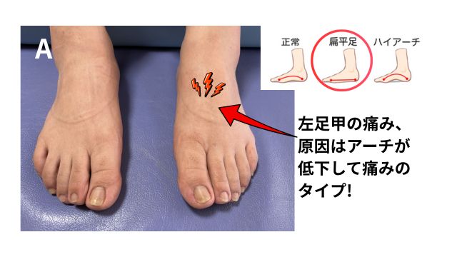 Aは、腫れが出ている方の逆の足甲の痛み