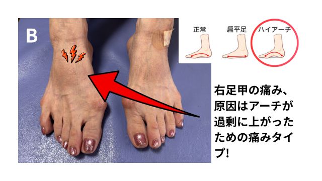 Bは、腫れが出ている方の足甲の痛み