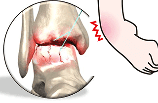 足首痛の原因は炎症