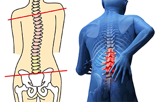 股関節の原因は腰痛